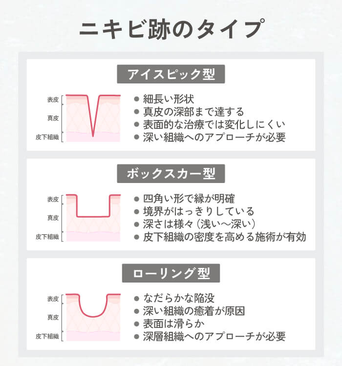 ニキビ跡のタイプ