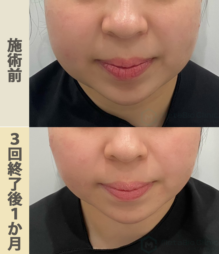 オンダプロ(オンダリフト)頬の施術前/3回終了後1か月 20代女性