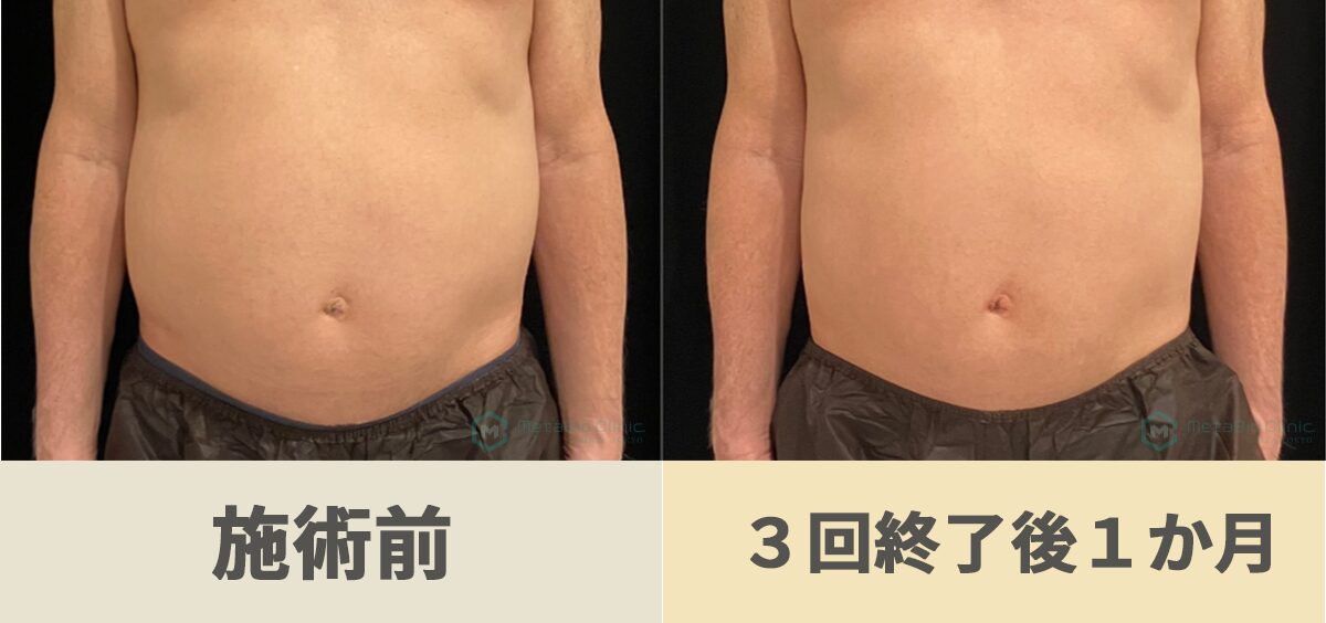 オンダプロお腹の施術前／３回終了後１か月 60代男性